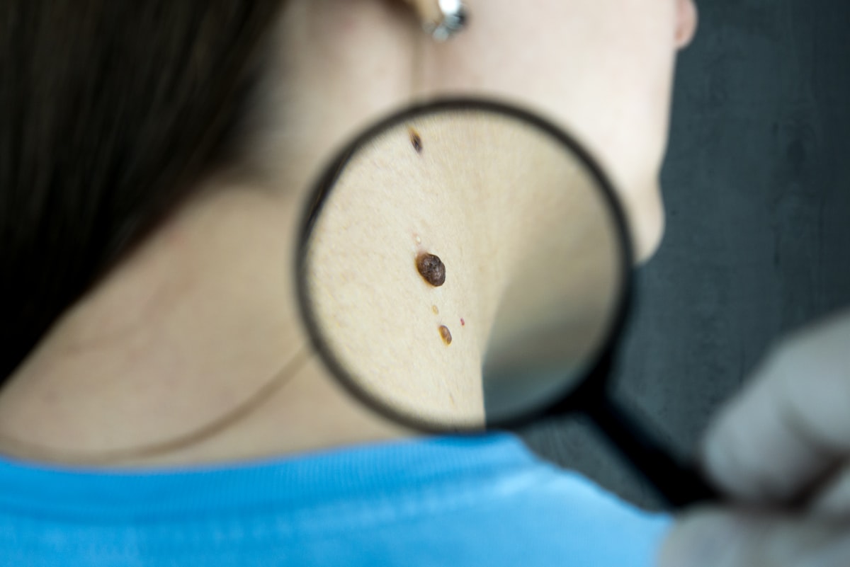 Mole & Skin Tag Removal at Enfield Royal Clinic Khalifa City